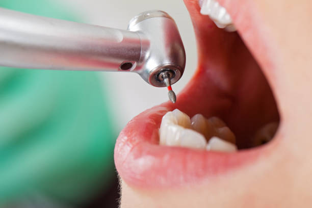 Best Emergency Dental Care for Broken or Chipped Teeth in Marshville, NC
